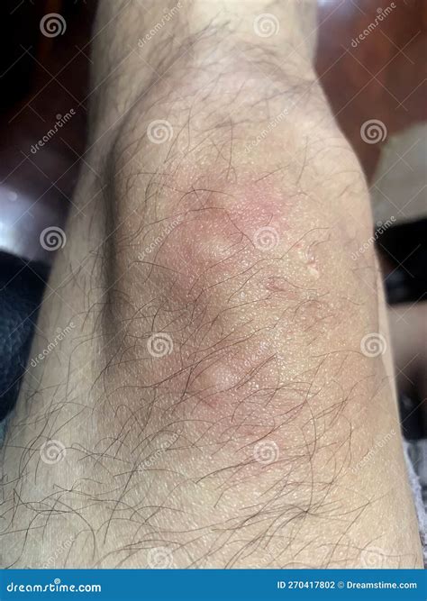 Also Biting the Skin. Scars of Mosquito Bites on the Skin of an Elderly