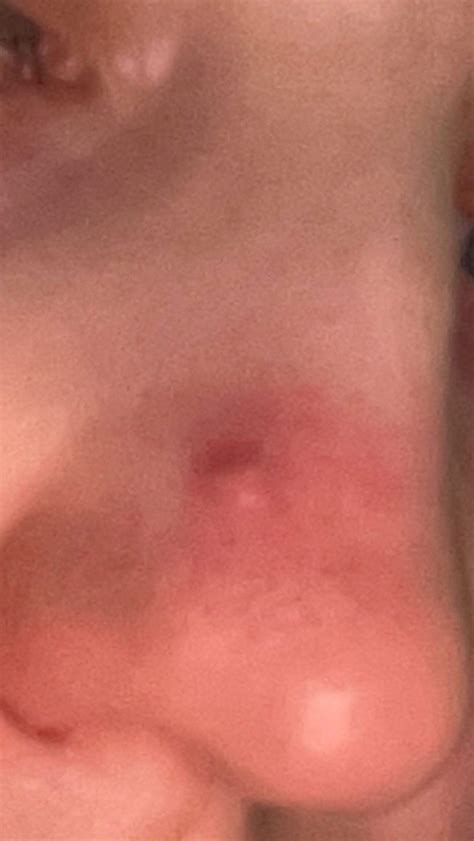 Pickel wie bekomme ich den Weg? (Hautprobleme, Gesichtspflege)