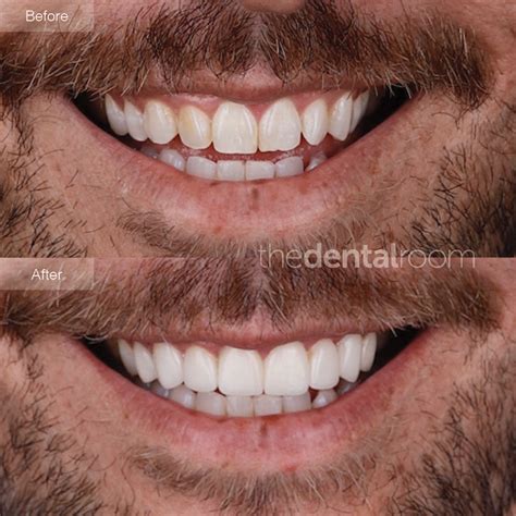 veneers    gaps    cosmetic dental