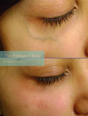 Veins Under Eyes - The Private Clinic of Harley Street London