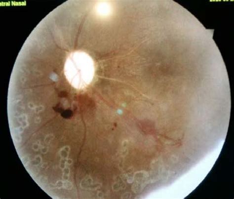 left funduscopic findings  scientific diagram