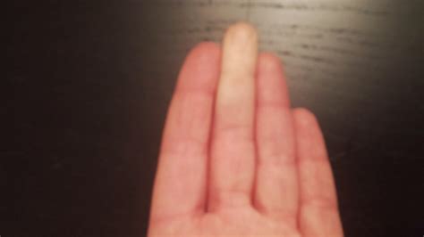 Raynaud's Syndrome: arteries spasm and reduce blood flow for a few