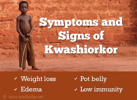 Signs And Symptoms Of Kwashiorkor