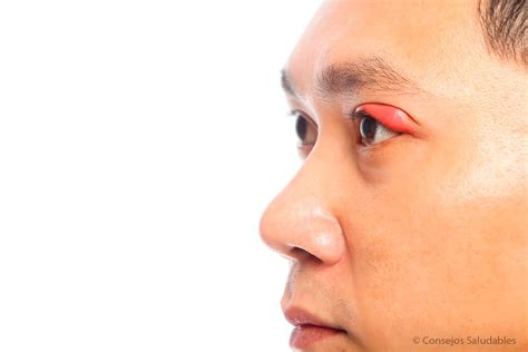 Orzuelos en los ojos: Causas, Prevención y Soluciones Caseras