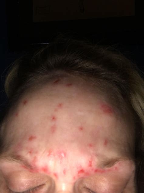 Picking my face - Skin picking - Acne.org