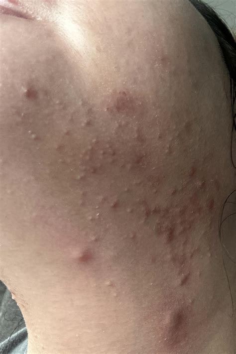 how to get rid of fungal acne 4