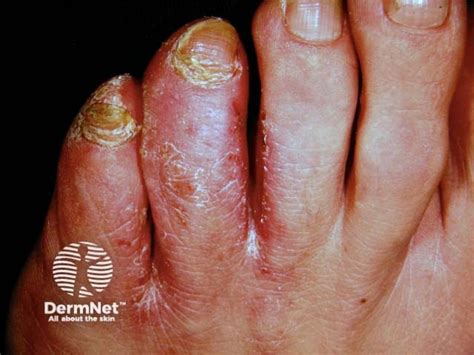 fungus  foot skin
