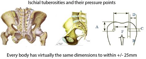 ischial tuberosities vss healthcare