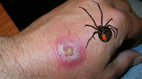 black widow spider bite pictures symptoms spider pedia