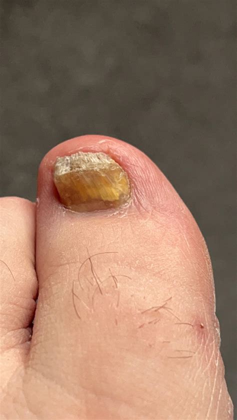 Thoughts on my big toe? Been like this for over a year, hasn’t hurt