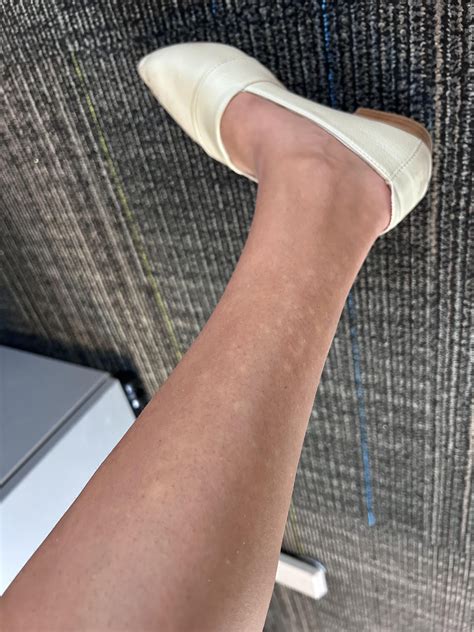 Help does this look like blood pooling? Not diagnosed yet but my doctor