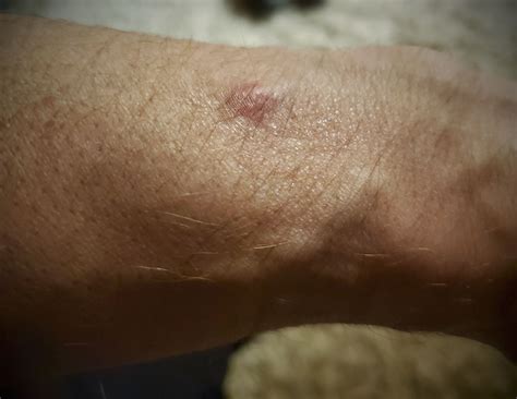 SAMSUNG Galaxy Watch 6 causes burn swelling and blisters within 1.5