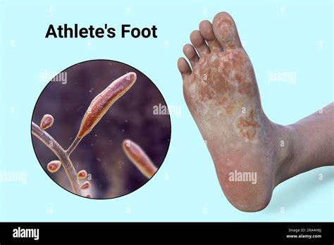 Athlete's Foot Canal Street at Keith Ramsay blog