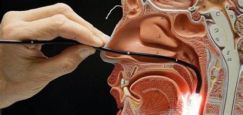 Nasofibrolaringoscopia O Que É - Exame de Nasofibrolaringoscopia - Santa Rita Clínica Médica