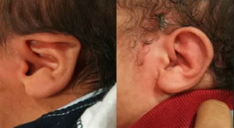 ear molding dr jill tomlinson
