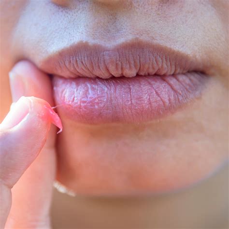 dark lips types  symptoms treatment