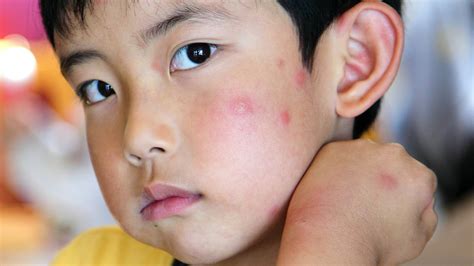 Mayo Clinic Minute: How to ease the itch of mosquito bites - Mayo