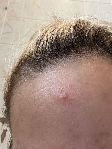 is this herpes? : r/PositiveHerpes
