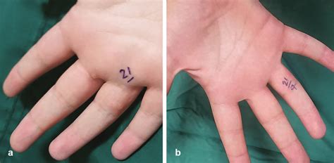 Multiple palmar warts (a) before treatment with the intralesional ...