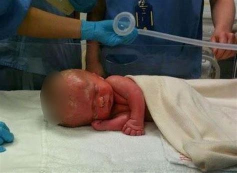 Baby born without a brain, '3 years later look at what doctors find ...