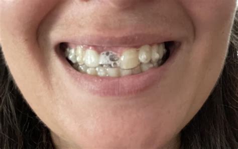 Dentist forgot I wanted a Pontic tooth… not sure what to do now : r ...