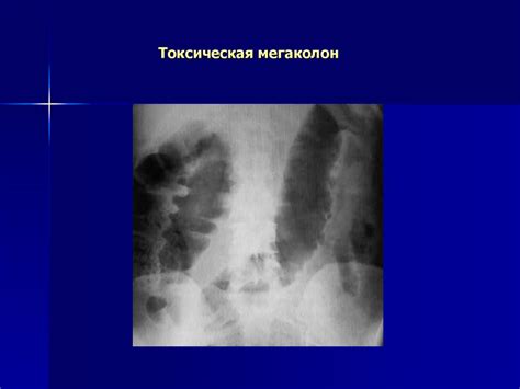 Методики исследования толстой кишки. Заболевания толстой кишки ...