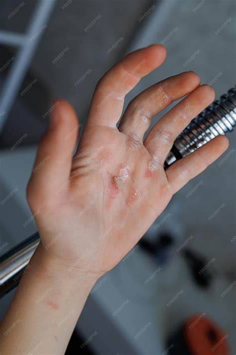 Premium Photo | Torn skin on the palm of my hand from a hard workout a