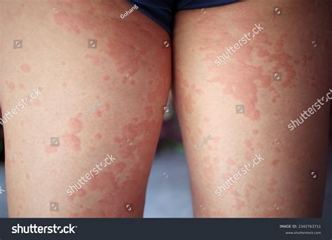 Allergic Reaction Rash On Legs