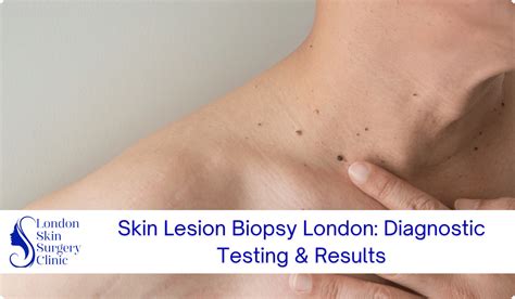 skin lesion biopsy london diagnostic testing results london skin