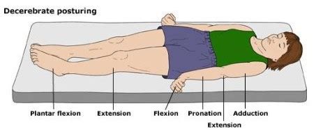 Decorticate Posture Gcs | Bruin Blog