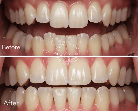 Before And After - Dental Arts on Essex