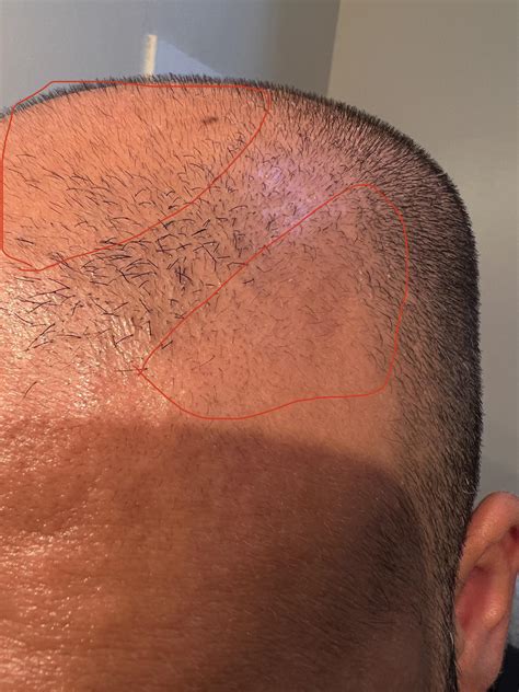 Signs of terminal hair growth? : r/tressless