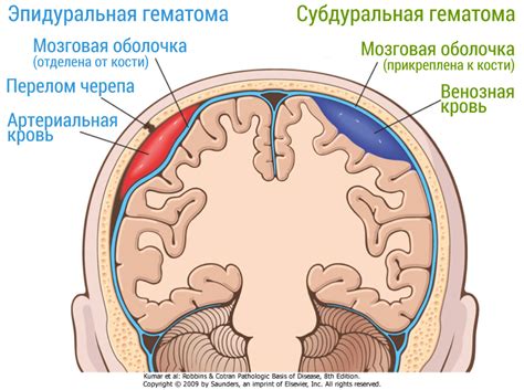 Гематома головного мозга