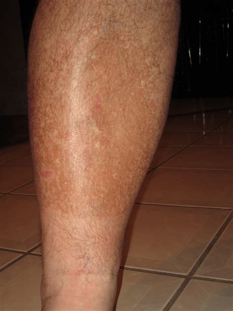 Brown Skin Discoloration On Lower Legs - dark spots on legs diabetes