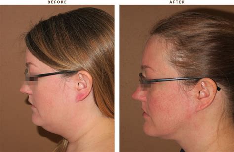 Liposuction of the Neck - Before and After Pictures | Dr Turowski - Plastic Surgery Chicago