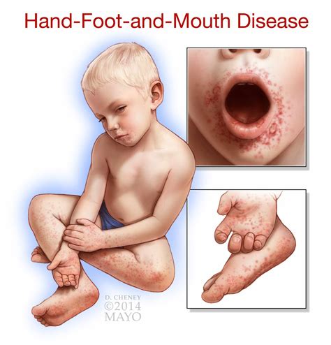 Hand Foot Mouth Rash On Face Deals | emergencydentistry.com
