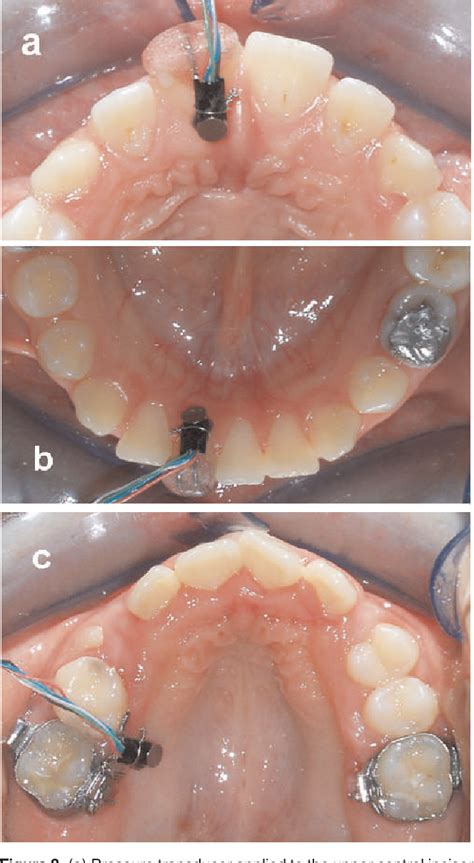 figure   tongue pressure      crib