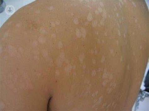 Todo lo que tienes que saber sobre las manchas blancas en la piel – Artofit