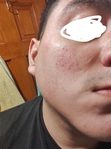 Red cheeks and pimples. : r/Skincare_Addiction