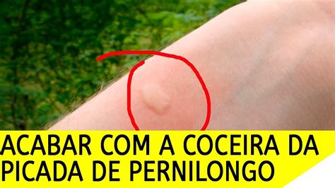 O Que Passar Na Picada De Pernilongo - COMO ACABAR COM A COCEIRA DA PICADA DE PERNILONGO E INSETOS - YouTube