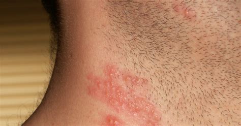 Itchy Rash On Neck Allergic Reaction at Kecia Martin blog