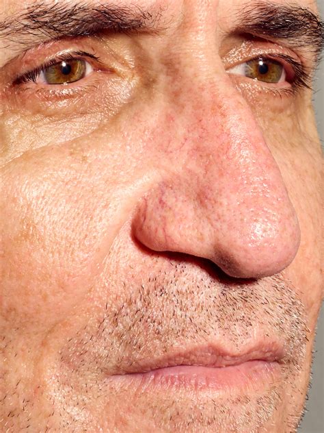 Blue Veins Around Mouth Child - Infoupdate.org