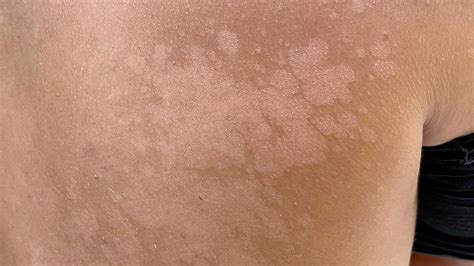 Tinea Versicolor: Symptoms, Causes, and Treatment