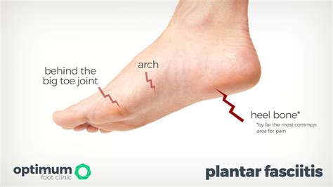 Plantar Fasciitis - Heel Pain Explained - Optimum Foot Clinic