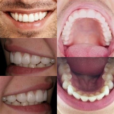 SMILE DENTAL TRANSFORMATION With VENEERS & CROWNS