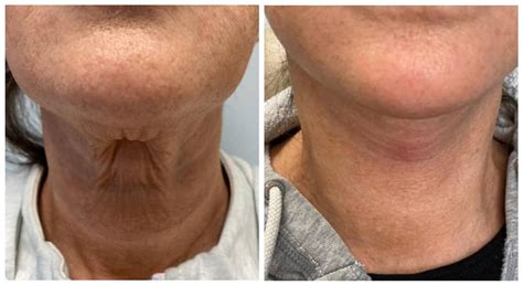 Mini Face Lift Boston - Weymouth MA - New England Cosmetic Surgery ...