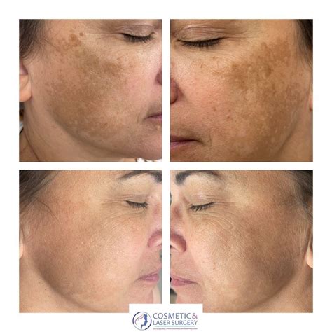 IPL Therapy — Cosmetic and Laser Surgery