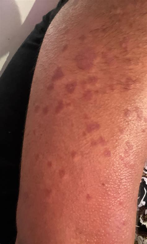 Rash on arms : r/DermatologyQuestions