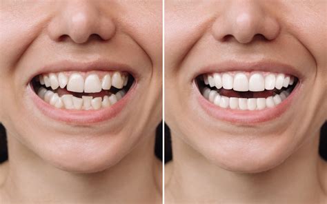 Effective Hydrogen Peroxide Teeth Whitening: A Guide