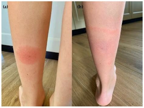 Erythema Migrans
